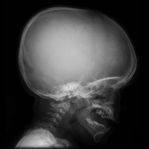 Case courtesy of Dr Frank Gaillard, Radiopaedia.org. From the case Achondroplasia